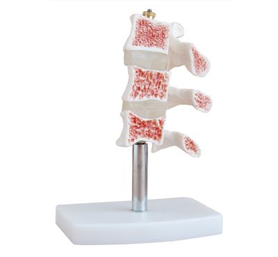 骨质疏松模型HK-A1015