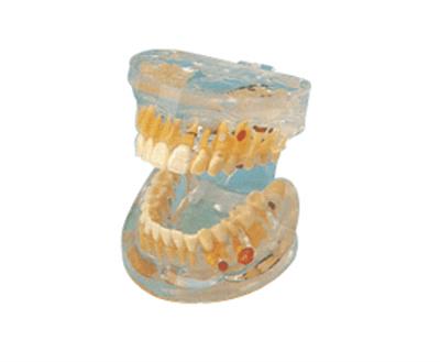 透明牙体病理模型HK-L1008