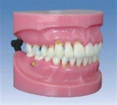 牙周病演示模型HK-L1022