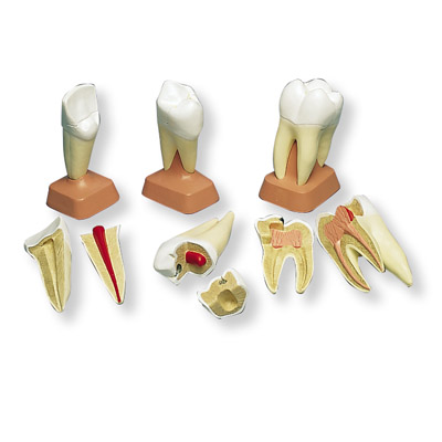 上颌三根龋臼齿模型(2部分)-VE298