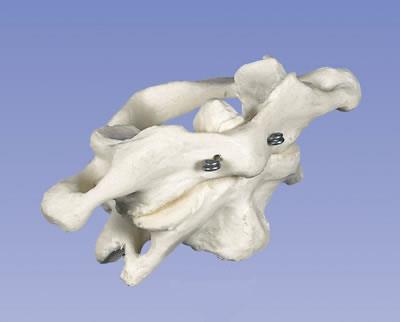 环椎和枢椎组合-无基架-德国3B-A71