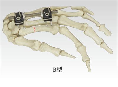 指掌骨骨折(B型)10109