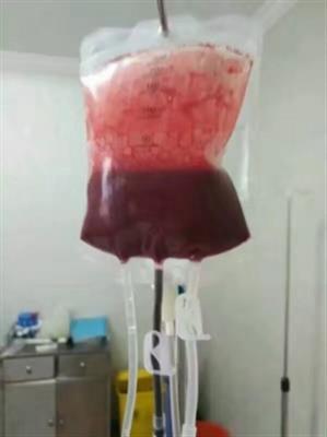 一次性使用塑料血袋输血器