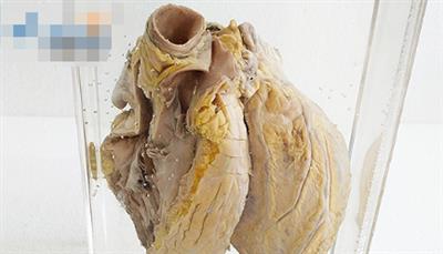 风湿性心脏病病理标本肠套叠